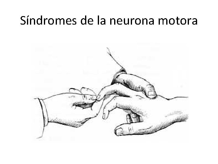 Síndromes de la neurona motora 