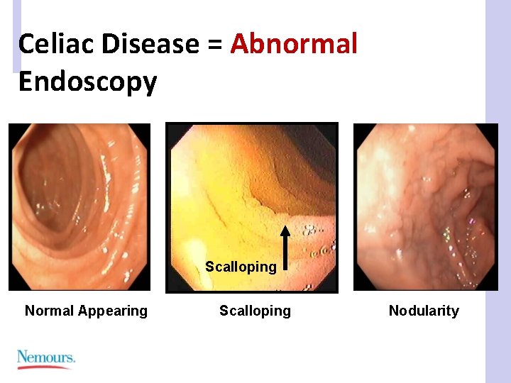 Celiac Disease = Abnormal Endoscopy Scalloping Normal Appearing Scalloping Nodularity 