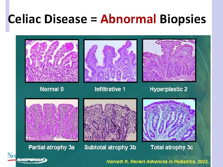 Celiac Disease = Abnormal Biopsies 