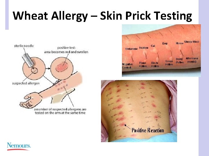 Wheat Allergy – Skin Prick Testing 