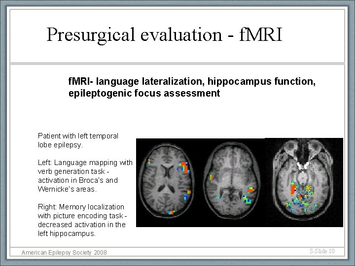 Presurgical evaluation - f. MRI- language lateralization, hippocampus function, epileptogenic focus assessment Patient with