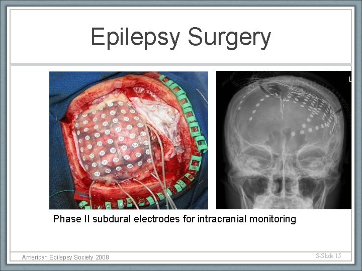 Epilepsy Surgery Phase II subdural electrodes for intracranial monitoring American Epilepsy Society 2008 S-Slide