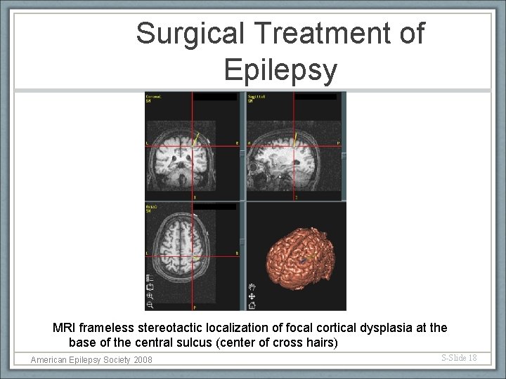 Surgical Treatment of Epilepsy MRI frameless stereotactic localization of focal cortical dysplasia at the