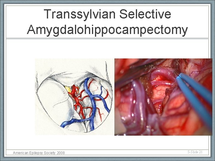 Transsylvian Selective Amygdalohippocampectomy American Epilepsy Society 2008 S-Slide 21 