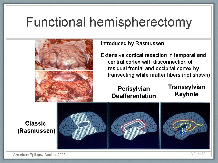 Functional hemispherectomy Introduced by Rasmussen Extensive cortical resection in temporal and central cortex with