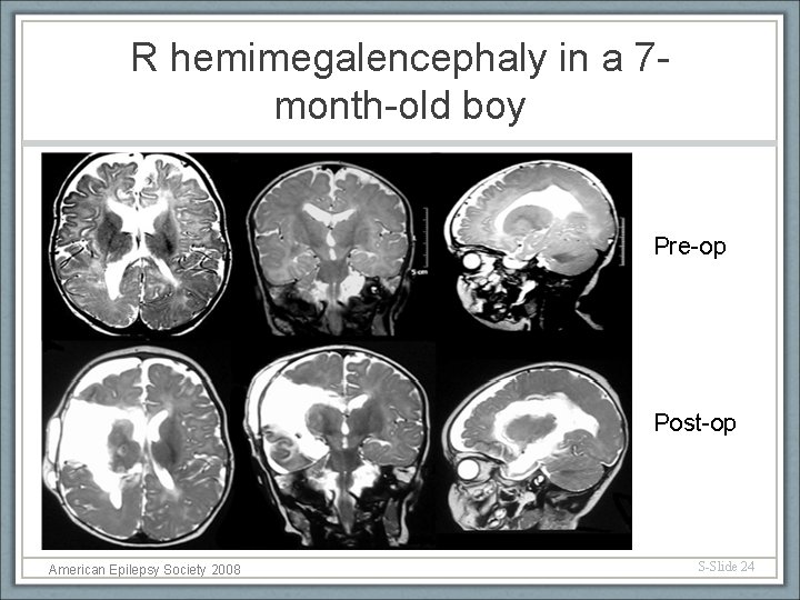 R hemimegalencephaly in a 7 month-old boy Pre-op Post-op American Epilepsy Society 2008 S-Slide