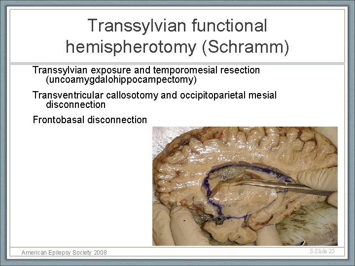 Transsylvian functional hemispherotomy (Schramm) Transsylvian exposure and temporomesial resection (uncoamygdalohippocampectomy) Transventricular callosotomy and occipitoparietal