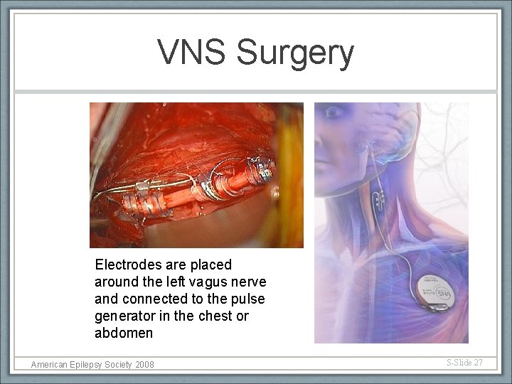 VNS Surgery Electrodes are placed around the left vagus nerve and connected to the