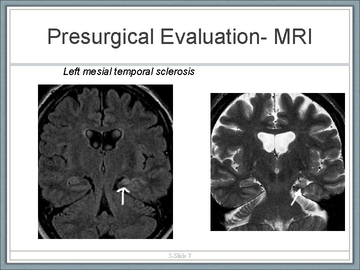 Presurgical Evaluation- MRI Left mesial temporal sclerosis S-Slide 7 