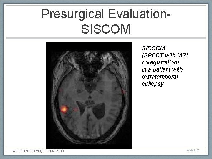 Presurgical Evaluation. SISCOM (SPECT with MRI coregistration) in a patient with extratemporal epilepsy American