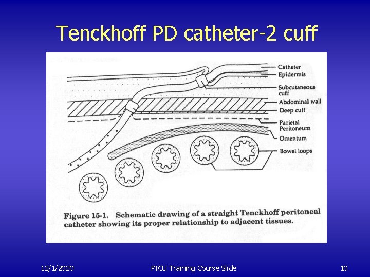 Tenckhoff PD catheter-2 cuff 12/1/2020 PICU Training Course Slide 10 