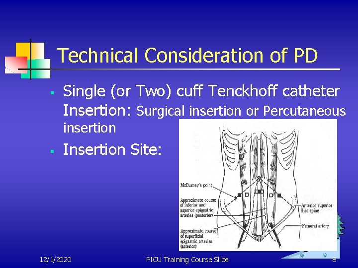 Technical Consideration of PD § Single (or Two) cuff Tenckhoff catheter Insertion: Surgical insertion