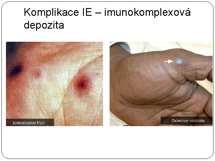 Komplikace IE – imunokomplexová depozita 
