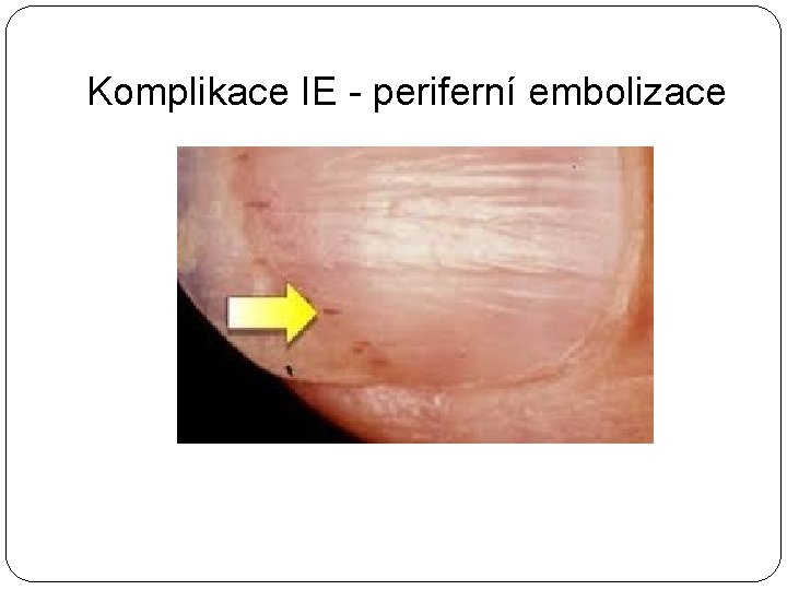 Komplikace IE - periferní embolizace 