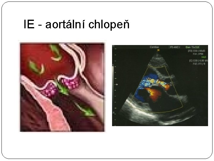 IE - aortální chlopeň 