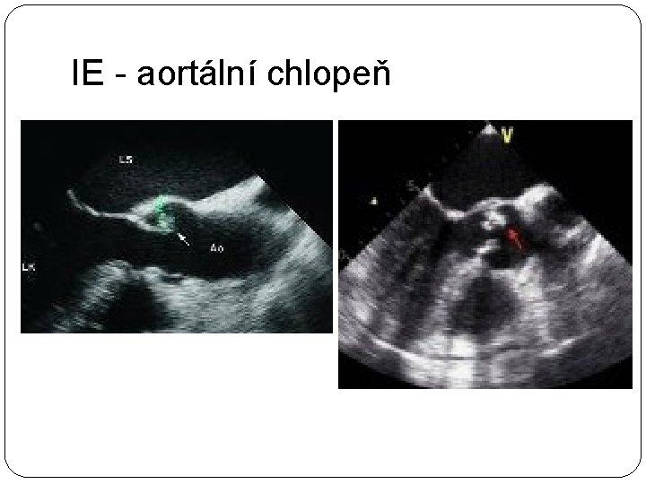 IE - aortální chlopeň 