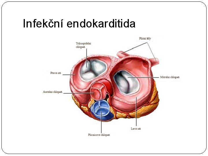 Infekční endokarditida 