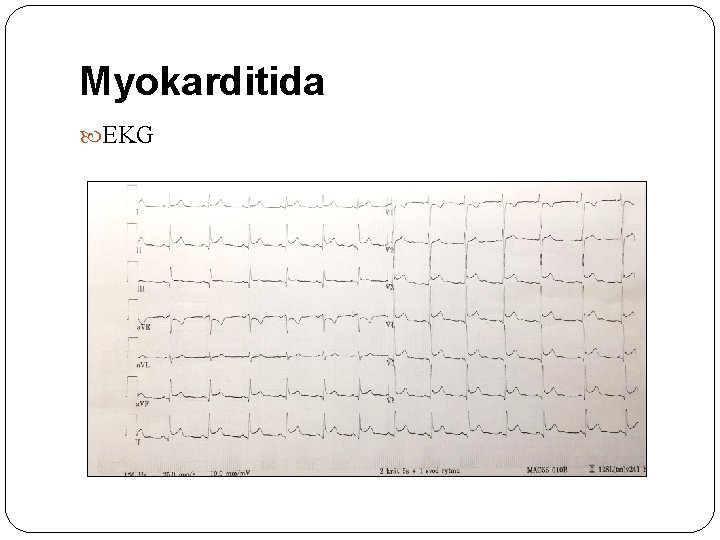 Myokarditida EKG 