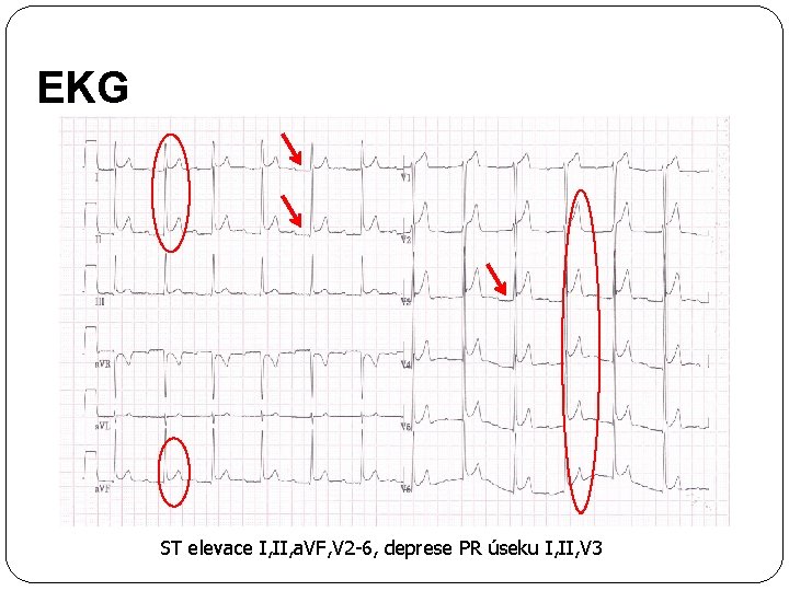 EKG ST elevace I, II, a. VF, V 2 -6, deprese PR úseku I,