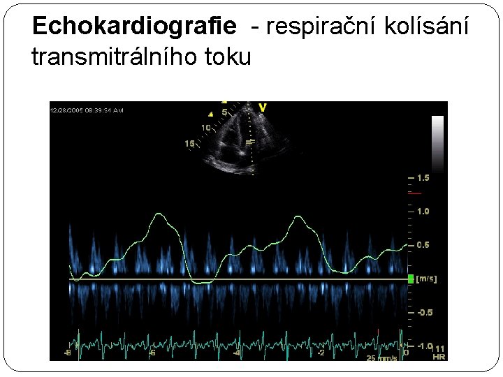 Echokardiografie - respirační kolísání transmitrálního toku 