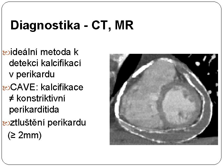 Diagnostika - CT, MR ideální metoda k detekci kalcifikací v perikardu CAVE: kalcifikace ≠
