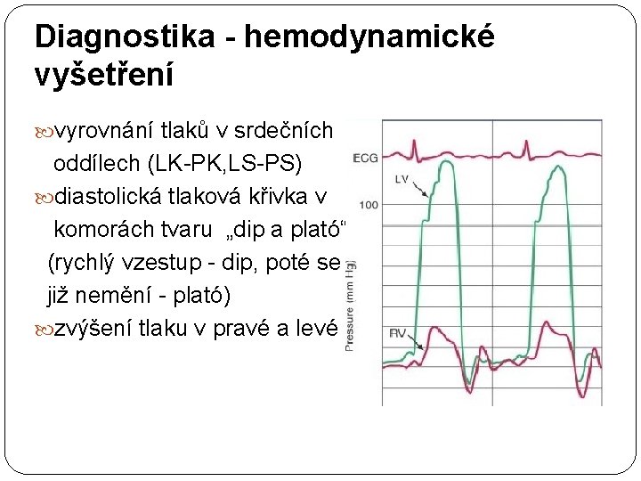 Diagnostika - hemodynamické vyšetření vyrovnání tlaků v srdečních oddílech (LK-PK, LS-PS) diastolická tlaková křivka