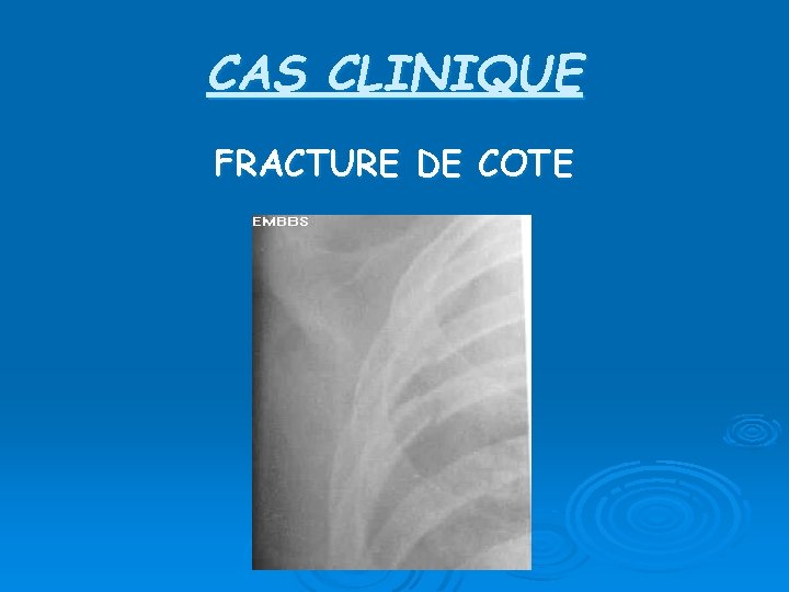 CAS CLINIQUE FRACTURE DE COTE 