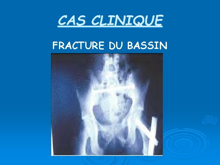 CAS CLINIQUE FRACTURE DU BASSIN 