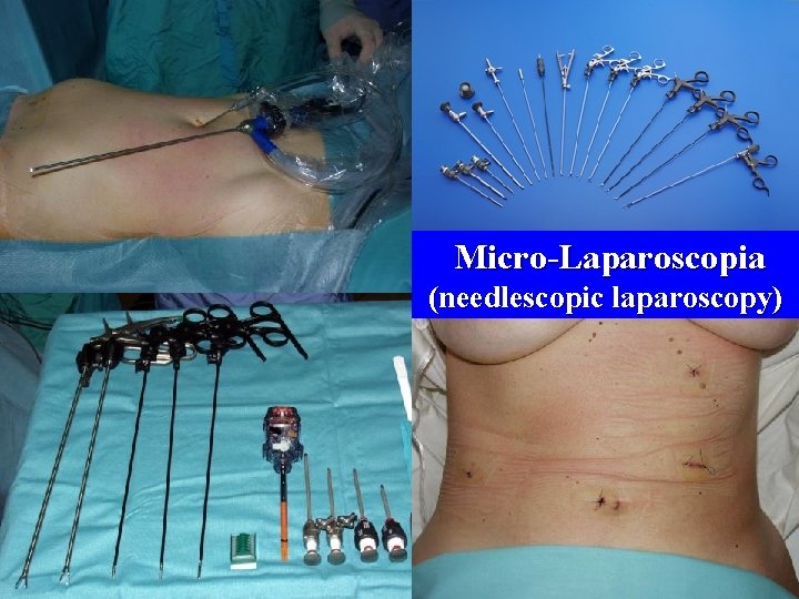 Micro-Laparoscopia (needlescopic laparoscopy) 