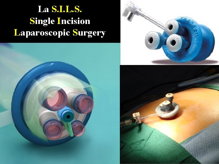 La S. I. L. S. Single Incision Laparoscopic Surgery 