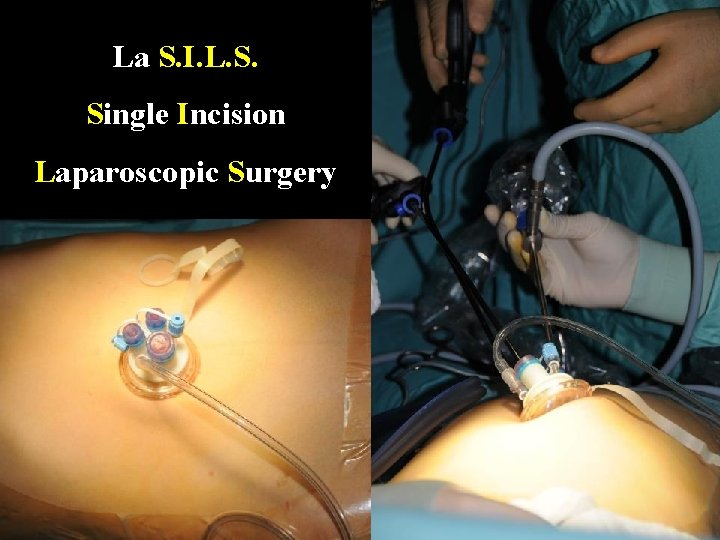 La S. I. L. S. Single Incision Laparoscopic Surgery 