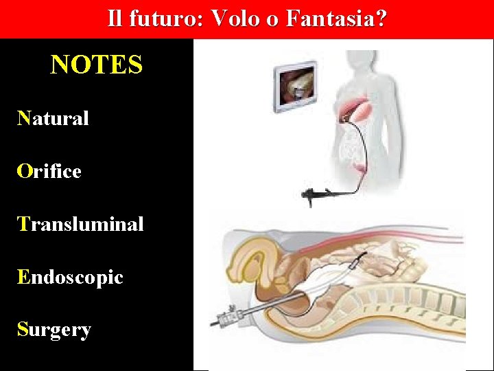Il futuro: Volo o Fantasia? NOTES Natural Orifice Transluminal Endoscopic Surgery 