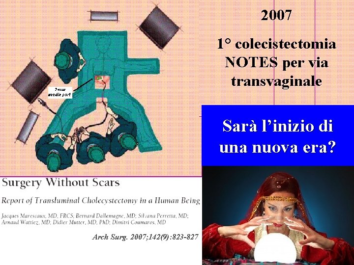 2007 1° colecistectomia NOTES per via transvaginale Sarà l’inizio di una nuova era? Arch