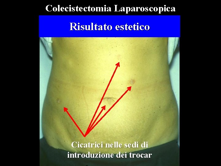 Colecistectomia Laparoscopica Risultato estetico Cicatrici nelle sedi di introduzione dei trocar 