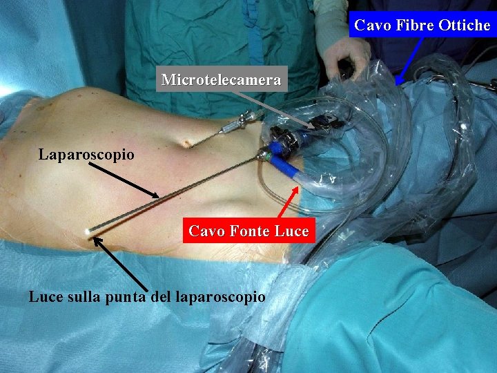 Cavo Fibre Ottiche Microtelecamera Laparoscopio Cavo Fonte Luce sulla punta del laparoscopio 