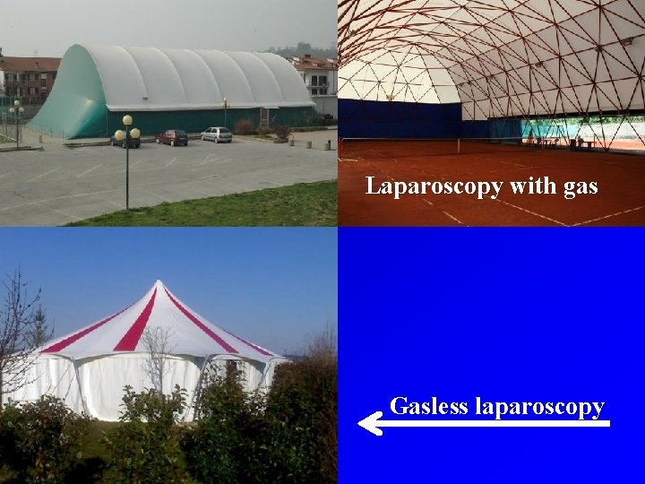Laparoscopy with gas Gasless laparoscopy 