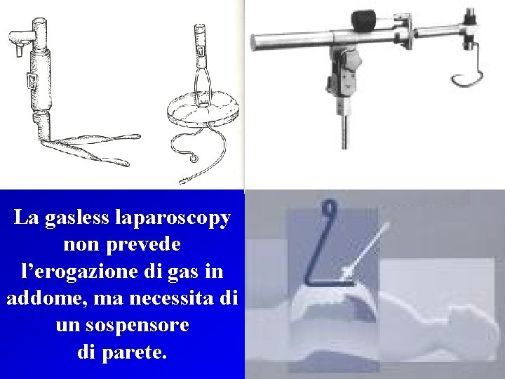 La gasless laparoscopy non prevede l’erogazione di gas in addome, ma necessita di un