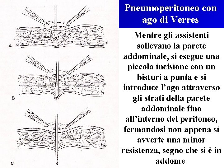 Pneumoperitoneo con ago di Verres Mentre gli assistenti sollevano la parete addominale, si esegue