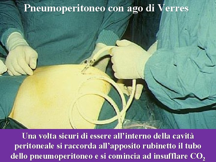 Pneumoperitoneo con ago di Verres Una volta sicuri di essere all’interno della cavità peritoneale