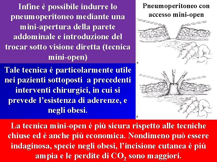 Infine è possibile indurre lo pneumoperitoneo mediante una mini-apertura della parete addominale e introduzione