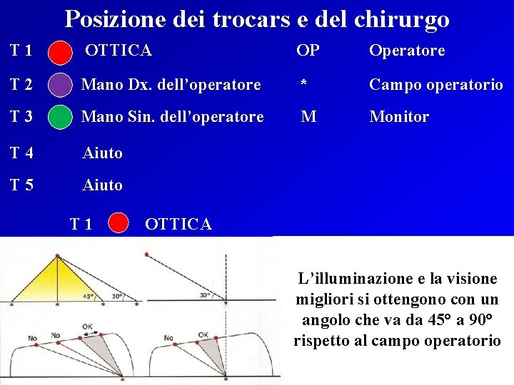 Posizione dei trocars e del chirurgo T 1 OTTICA OP Operatore T 2 Mano
