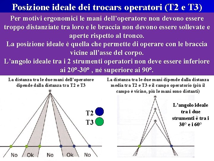 Posizione ideale dei trocars operatori (T 2 e T 3) Per motivi ergonomici le