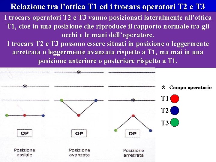 Relazione tra l’ottica T 1 ed i trocars operatori T 2 e T 3