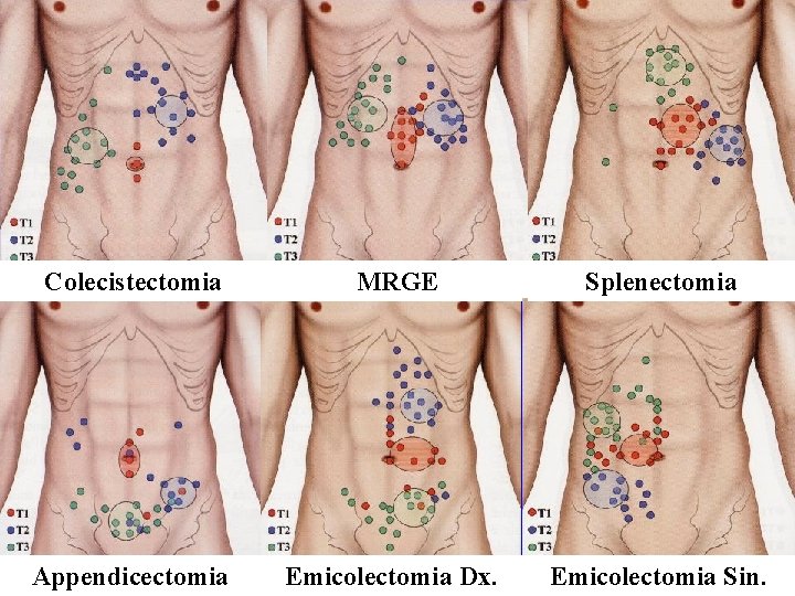 Colecistectomia MRGE Splenectomia Appendicectomia Emicolectomia Dx. Emicolectomia Sin. 