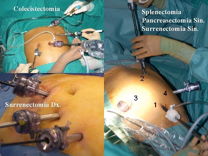 Colecistectomia Surrenectomia Dx. Splenectomia Pancreasectomia Sin. Surrenectomia Sin. 