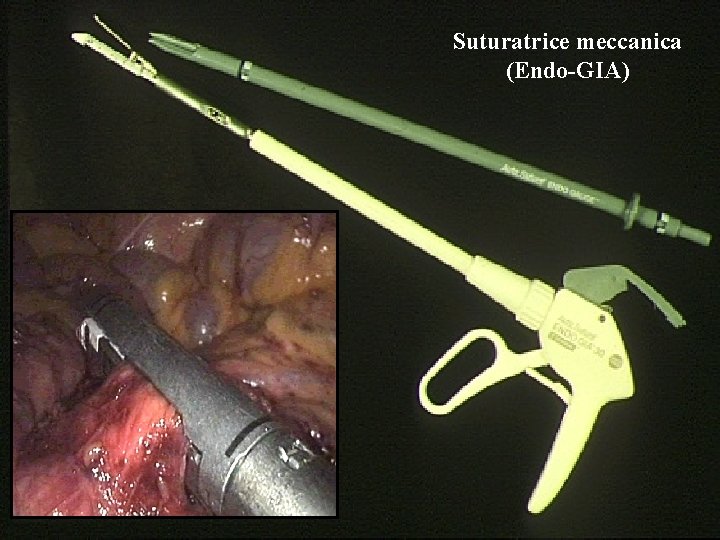 Suturatrice meccanica (Endo-GIA) 