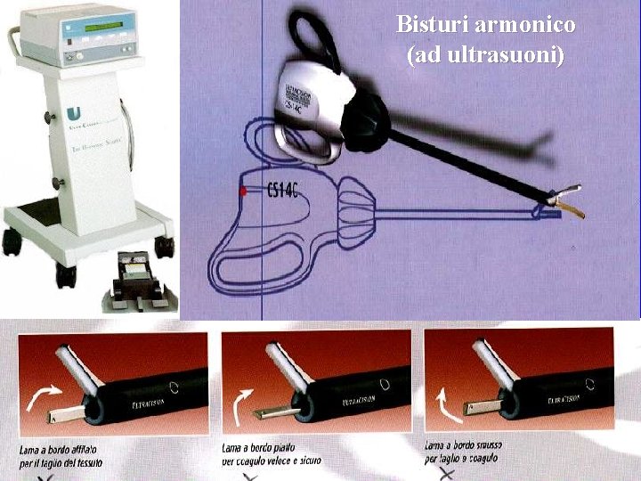 Bisturi armonico (ad ultrasuoni) 