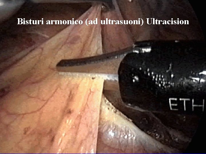 Bisturi armonico (ad ultrasuoni) Ultracision 