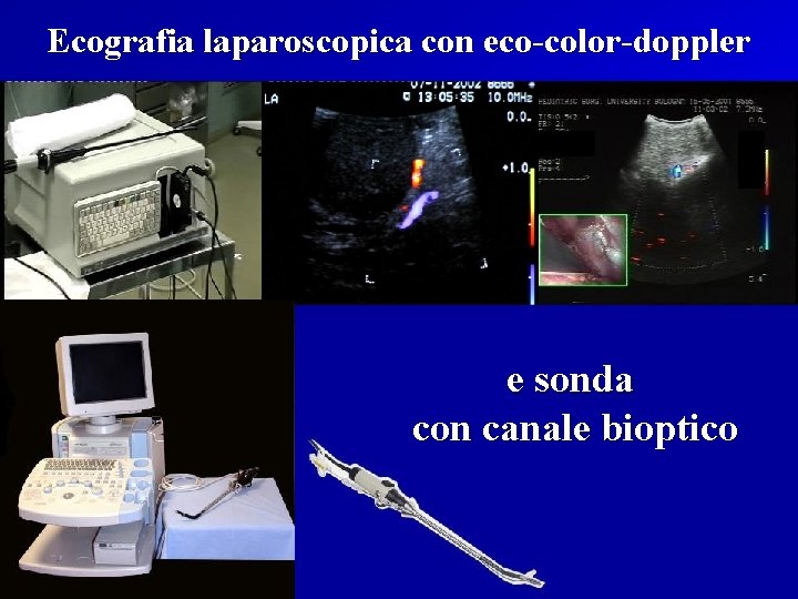 Ecografia laparoscopica con eco-color-doppler e sonda con canale bioptico 