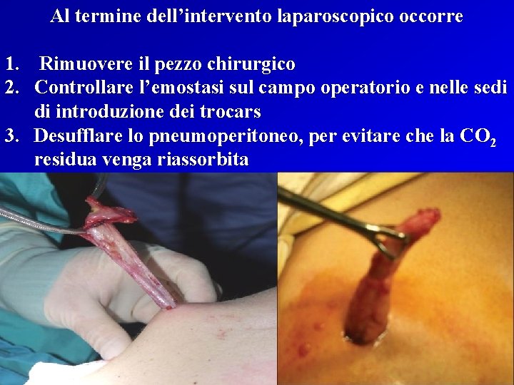 Al termine dell’intervento laparoscopico occorre 1. Rimuovere il pezzo chirurgico 2. Controllare l’emostasi sul